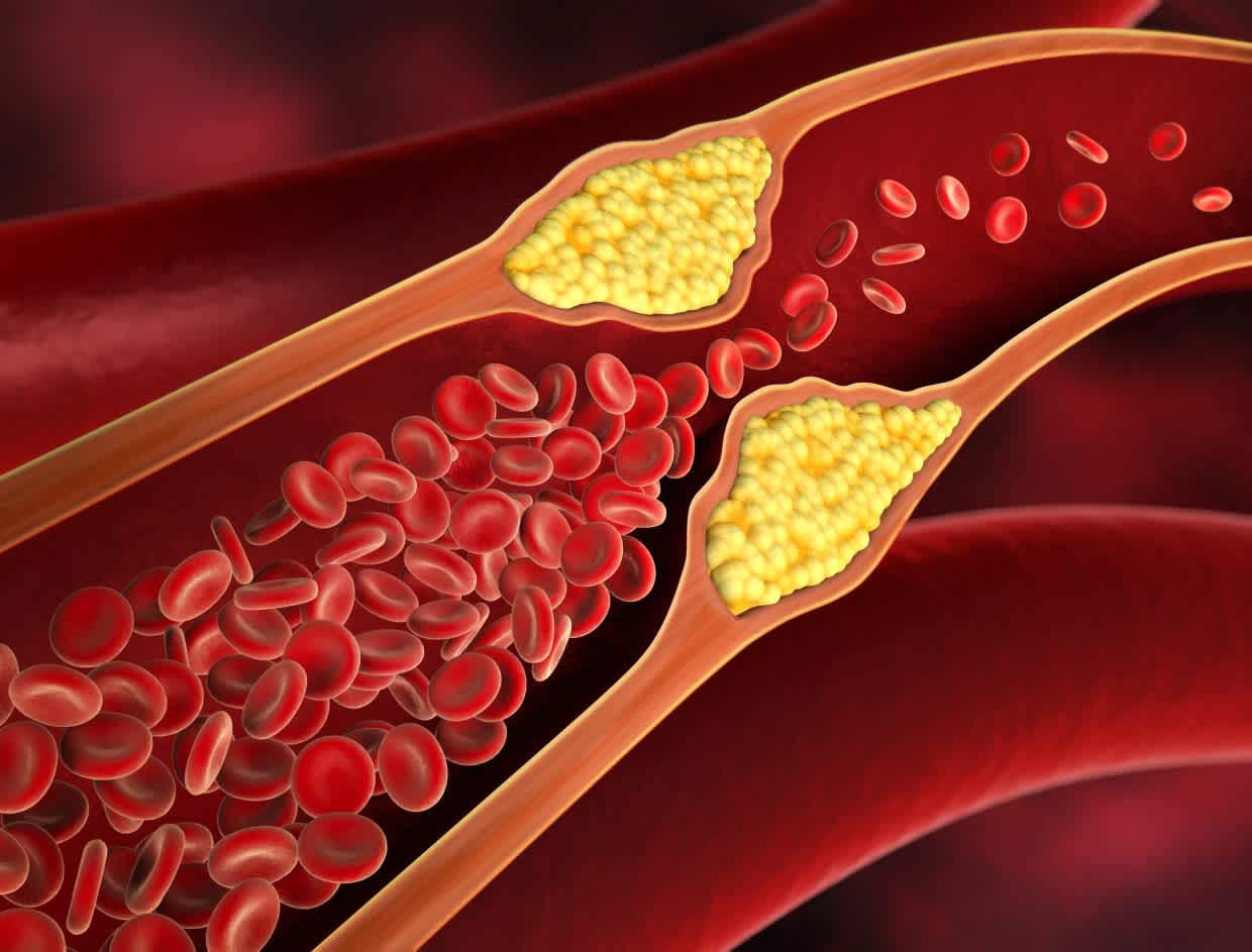 What are 10 Warning Signs of High Cholesterol